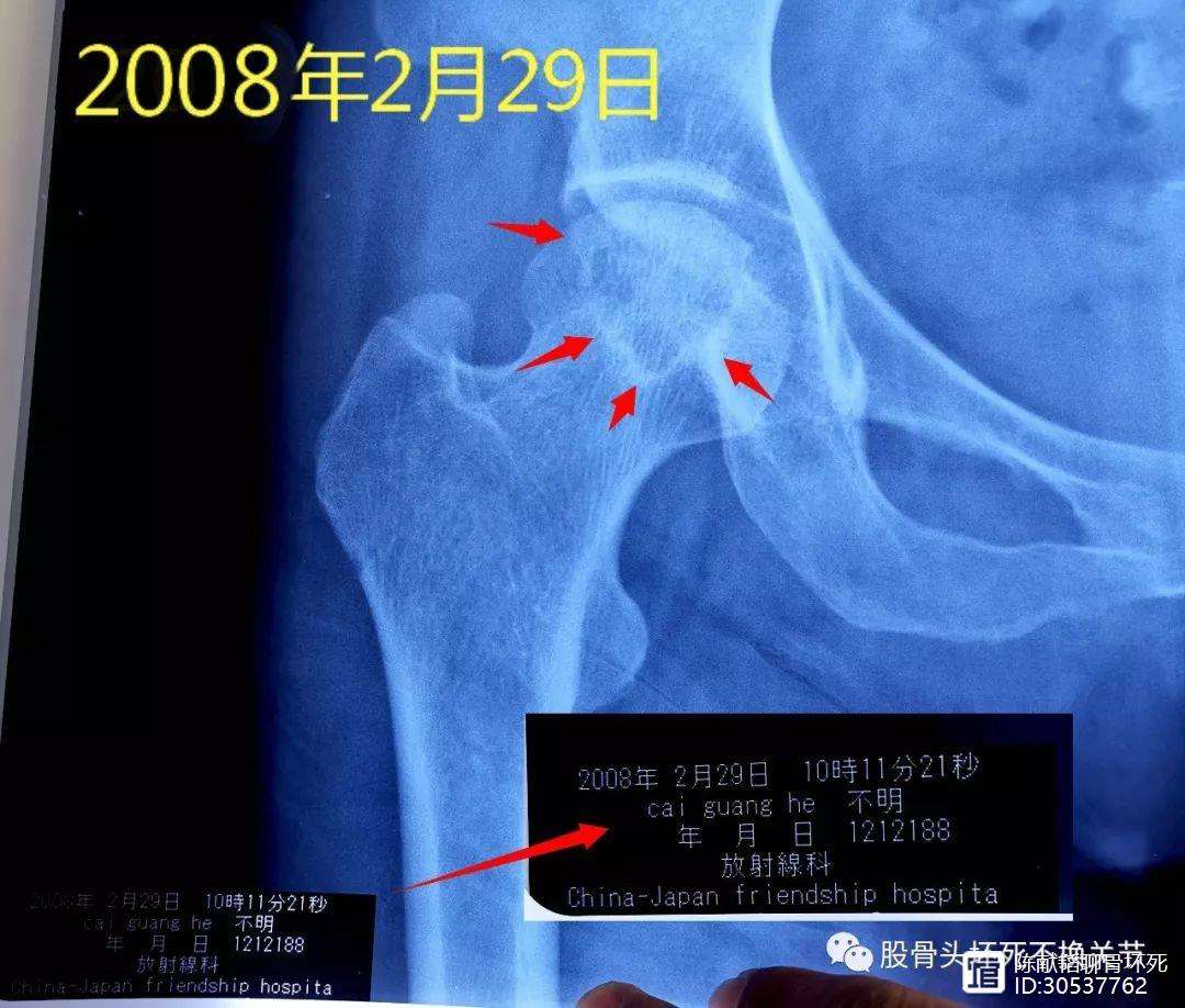 永川人工骨头医保报销多少(人工骨头医保报销多少比例)