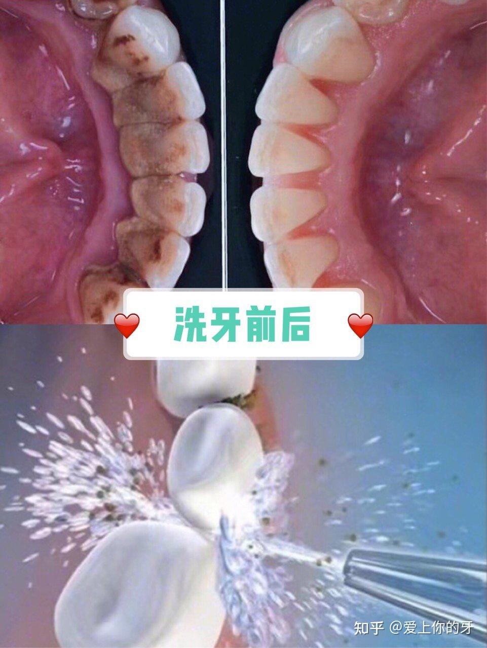 永川洗牙可以用医保吗(洗牙可以用医保吗,报销比例多少)
